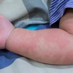 Más de 100 niños con enfermedad rara