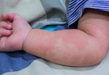 Más de 100 niños con enfermedad rara