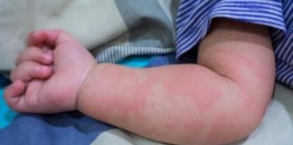 Más de 100 niños con enfermedad rara