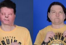 Composición de dos fotografías cedidas por el hospital NYU Langone de Nueva York donde se muestra el antes de después del trasplante de cara y de las dos manos a Joe DiMeo, un paciente de 22 años de Nueva Jersey. EFE/NYU Langone