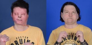 Composición de dos fotografías cedidas por el hospital NYU Langone de Nueva York donde se muestra el antes de después del trasplante de cara y de las dos manos a Joe DiMeo, un paciente de 22 años de Nueva Jersey. EFE/NYU Langone